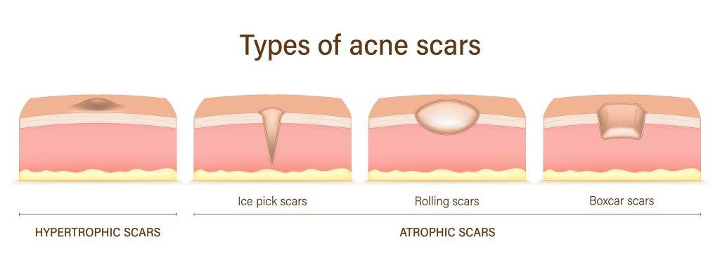 Types,Of,Acne,Scars.,Facial,Skin,Problems.,Hypertrophic,Scars,And