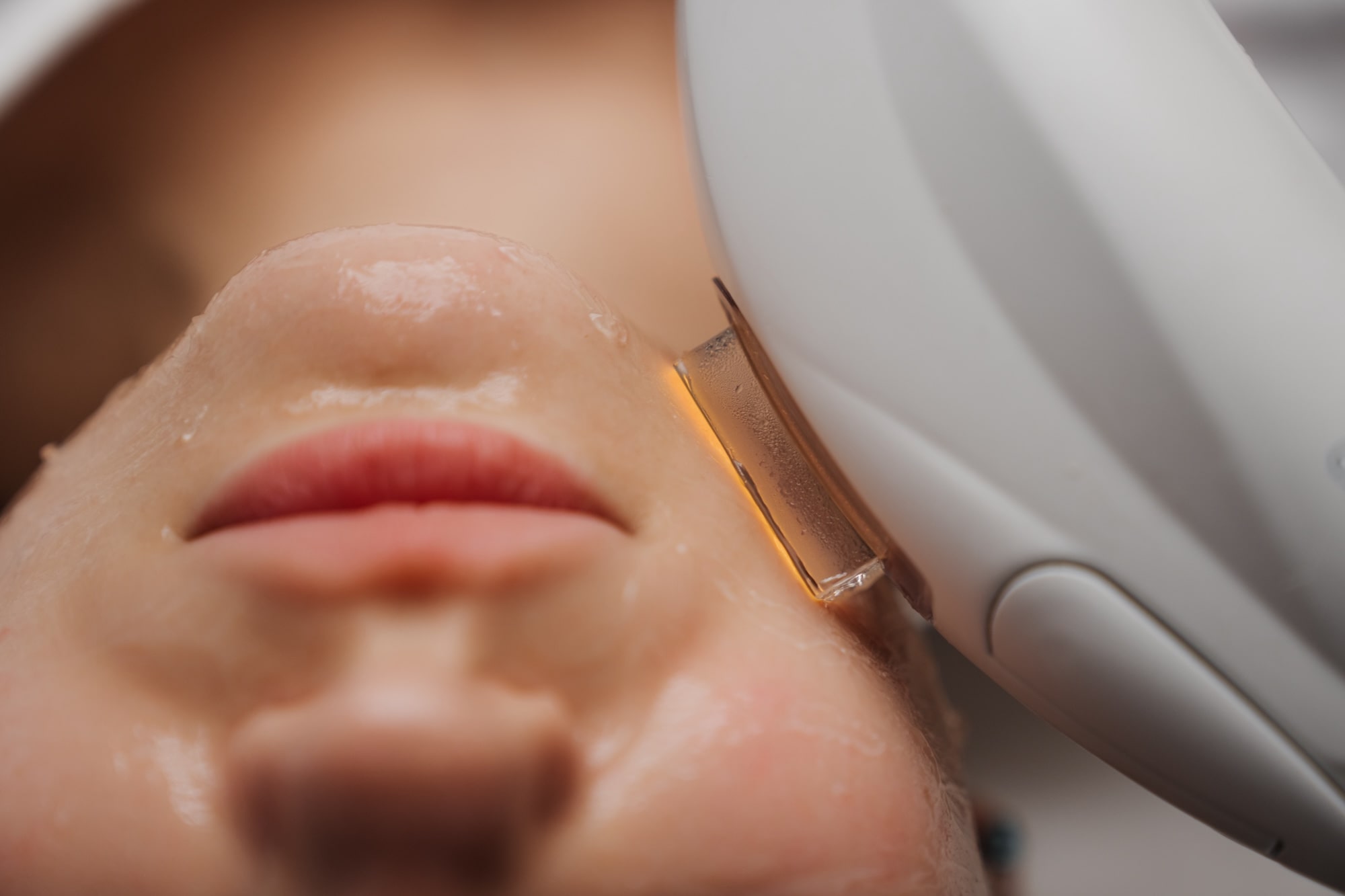 radiofrequency microneedling