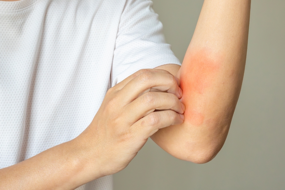 The Eczema Itch Switch Scientists Finally Turned Off