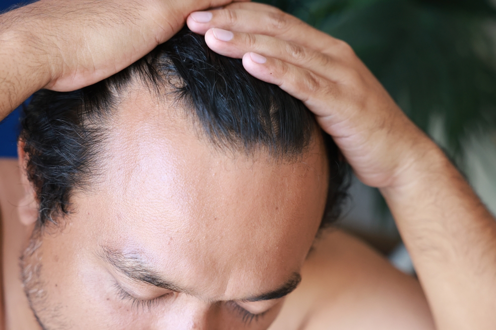 Why Are More Young Adults Losing Their Hair?