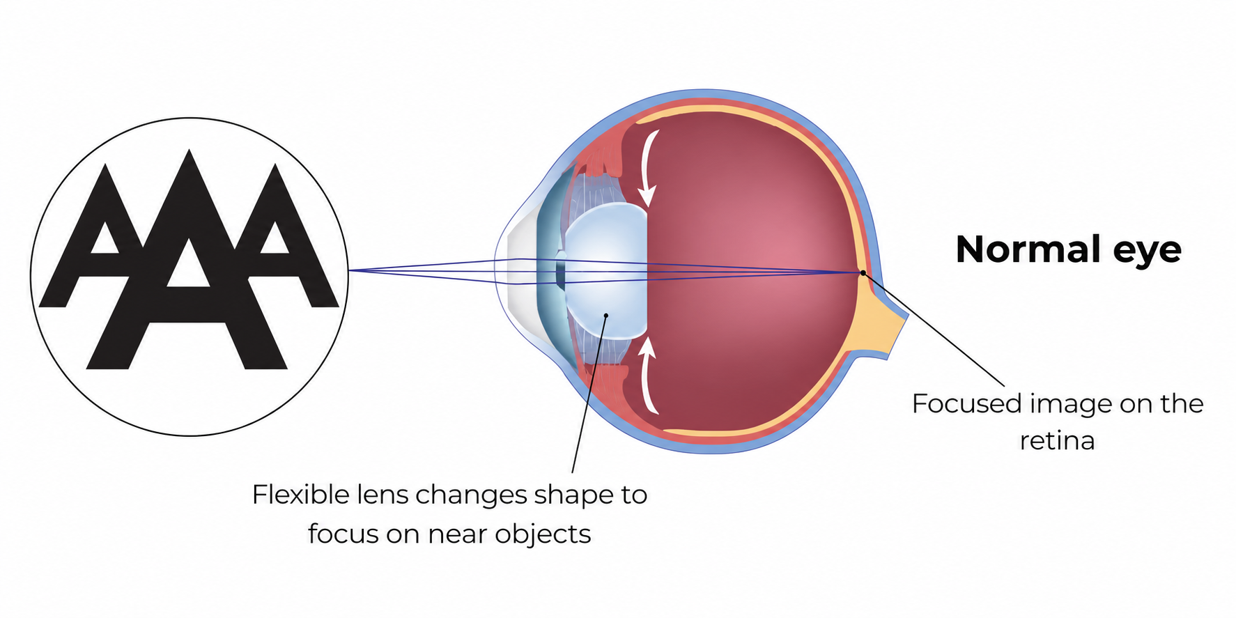 Cross-section of an eye with a flexible lens focusing a near object on the retina.