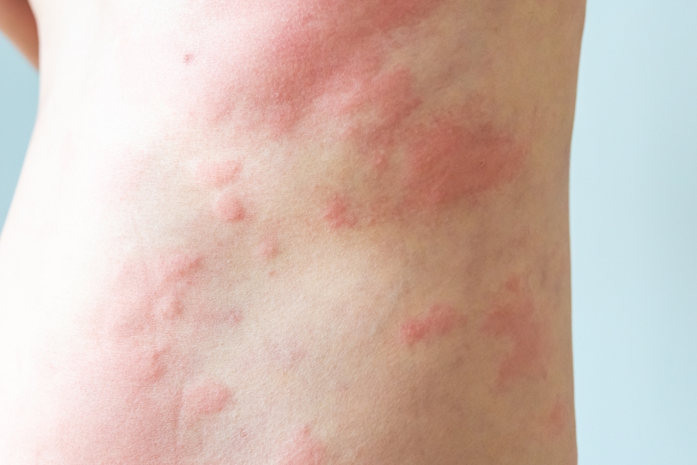 The Hives Keep Coming. Is Allergy Really To Blame?